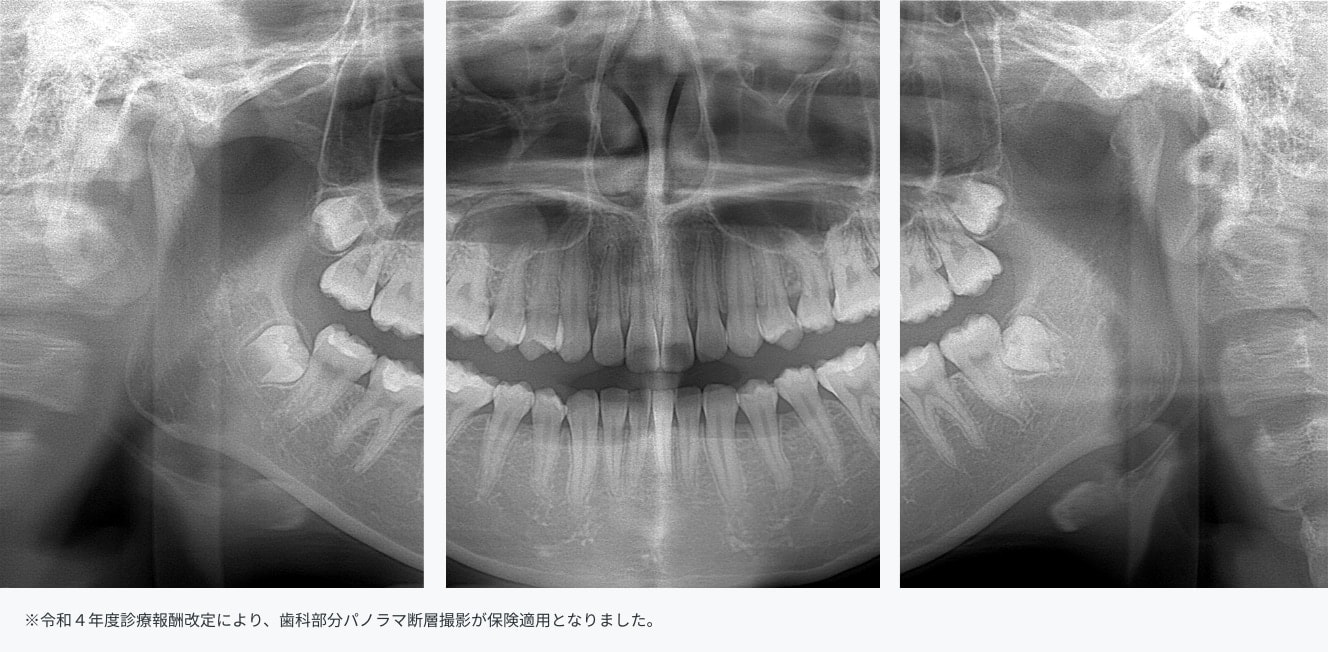 ※令和４年度診療報酬改定により、歯科部分パノラマ断層撮影が保険適用となりました。