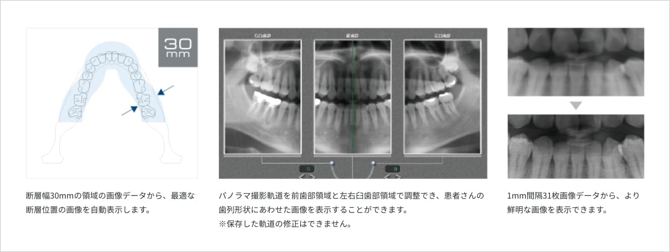 断層幅30mmの領域の画像データから、最適な断層位置の画像を自動表示します。パノラマ撮影軌道を前歯部領域と左右臼歯部領域で調整でき、患者さんの歯列形状にあわせた画像を表示することができます。※保存した軌道の修正はできません。1mm間隔31枚画像データから、より鮮明な画像を表示できます。